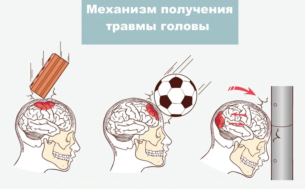 Сотрясение 6. Черепно-мозговая травма. Черепно мозговая травма вектор. Травмированные черепа.