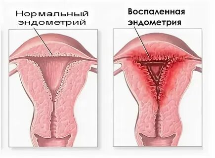 Кровоточит эндометрий