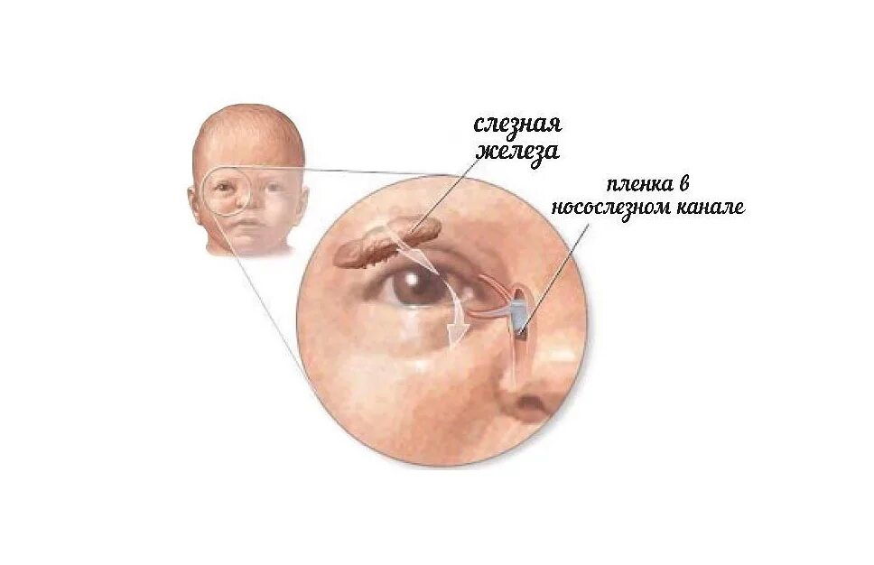 Слезный канал открывается. Зондирование слезного канала у новорожденных Москва. Зондирование носослезного канала. Дакриоцистит массаж слезного канала у новорожденных.