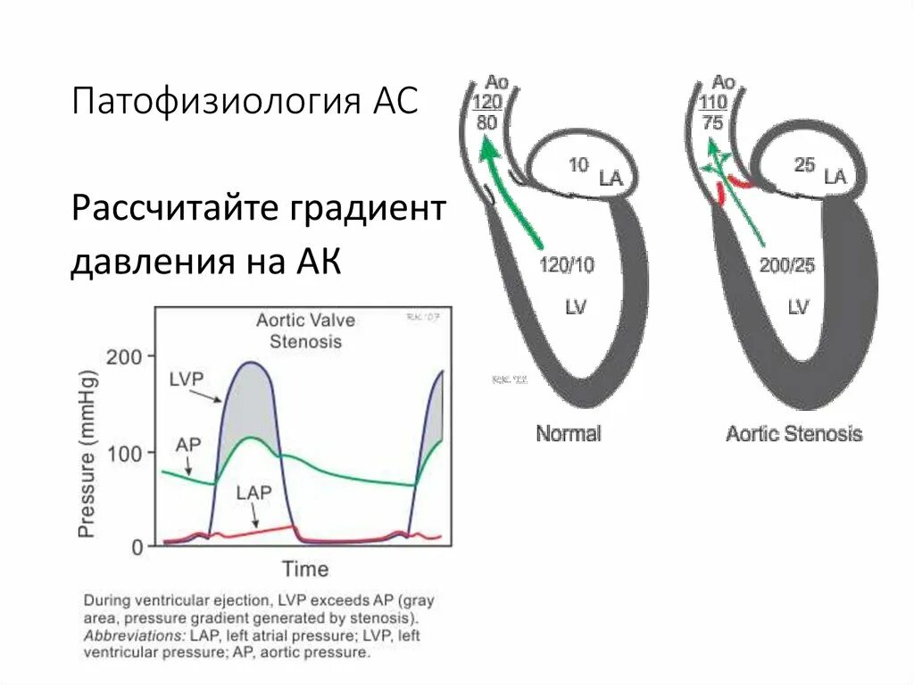 Нормальный градиент давления на аортальном клапане. Аортальный стеноз эхокг. Градиент давления пиковый норма. Пиковый градиент. Стеноз аортального клапана узи.