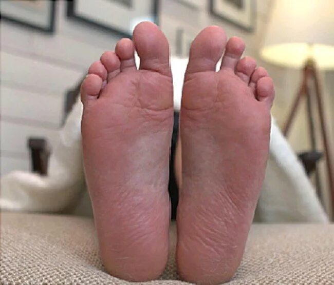 Метатарзалгия стопы фото. Pain for feet. Devine feet