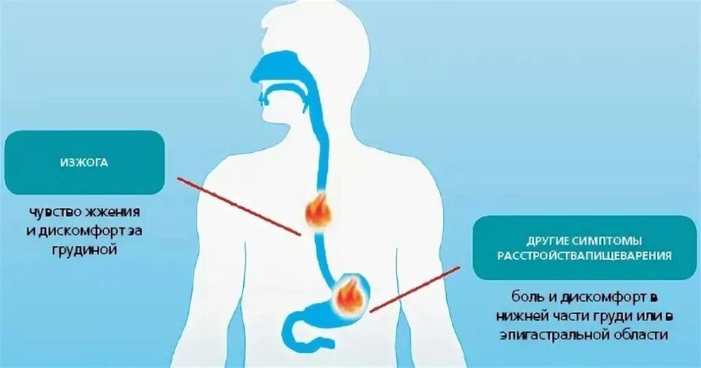 Изжога причины у мужчин после 60. Симптомы изжоги желудка.