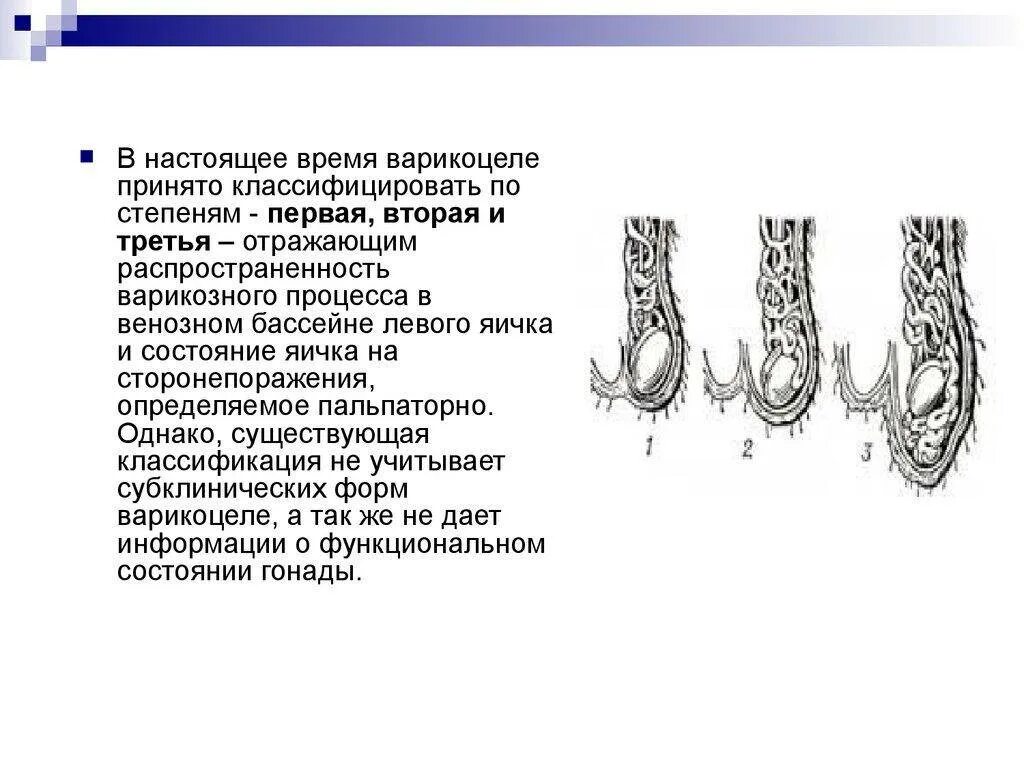 Варикозное расширение вен семенного канатика III степени. Варикозное расширение вен семенного канатика II степени. Варикоцеле расширение 3мм. Варикоз яичка 3 степени слева. У мужчины болят яички причины и лечение