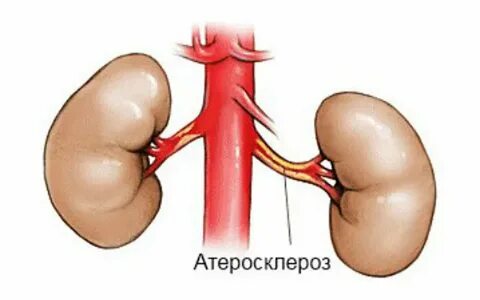 Почечная артерия симптомы