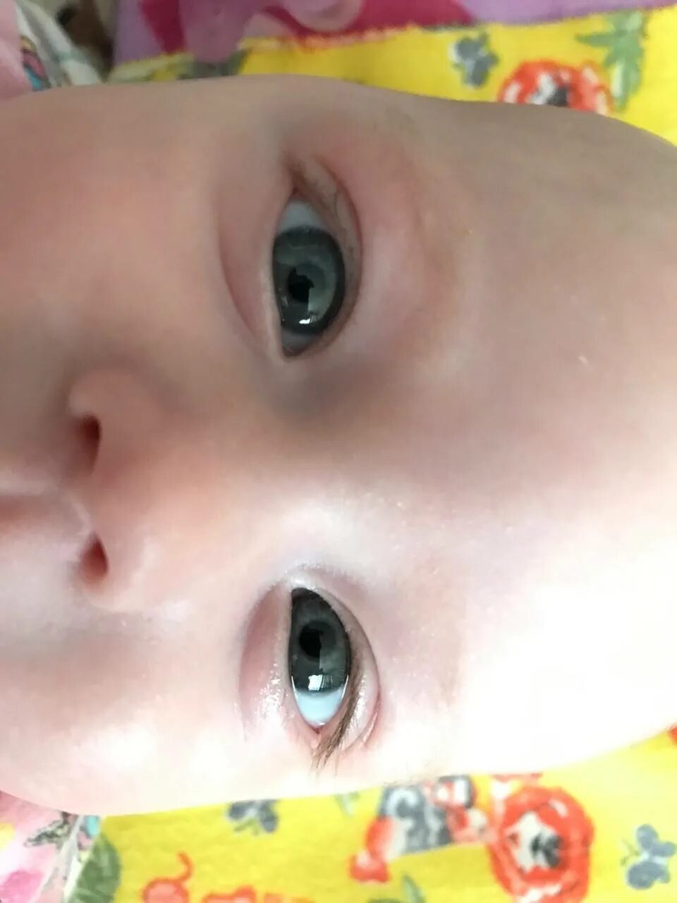 Почему у новорожденного глазки. Конъюнктивит и дакриоцистит новорожденных. Конъюнктивит у грудничка. Глаза месячного ребенка. Слезится глаз у грудничка.