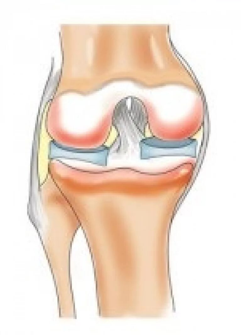 Мениск коленного сустава жидкость. Разрыв мениска симптомы. Связки мениска коленного сустава. Строение колена мениск. Поврежденный мениск коленного сустава