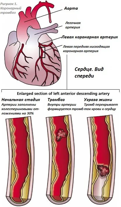 Тромбоз венечных артерий сердца. Тромб коронарных артерий сердца. Тромбоэмболии коронарного сосуда. Тромб в коронарной артерии. Тромбоз артерий лечение