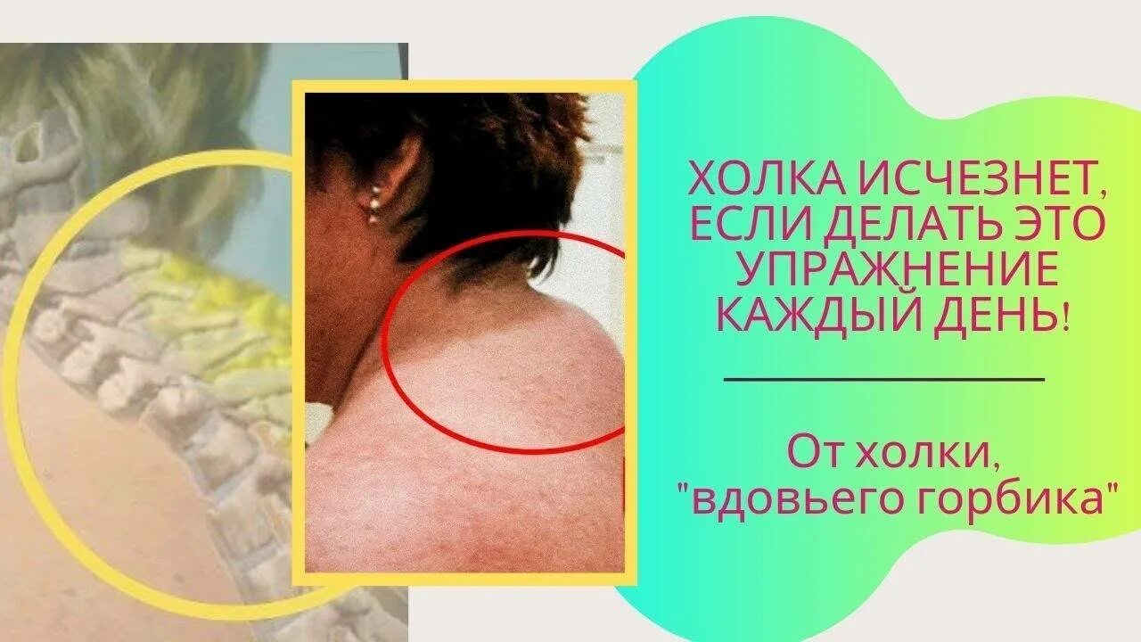 Как лечить холку