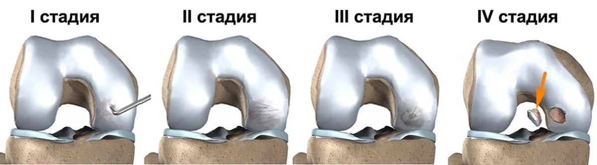 Хондромаляция медиального мыщелка. Остеохондропатия Кенига. Остеохондропатии болезнь Кенига. Болезнь Кёнига коленного сустава 2 степени. Остеохондропатия бедренной кости Кенига.