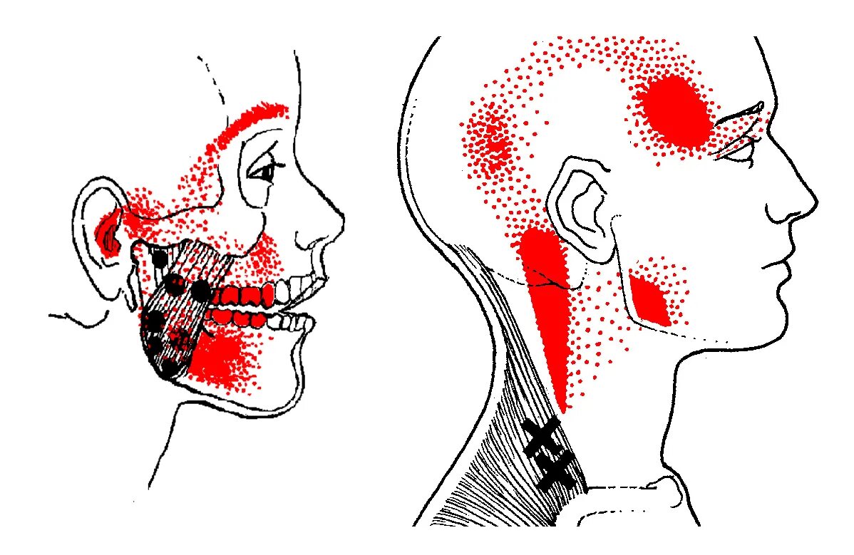 Боль в челюсти. Миофасциальный болевой синдром триггерные точки. Триггерные точки при дисфункции ВНЧС. Триггерные точки жевательных мышц.