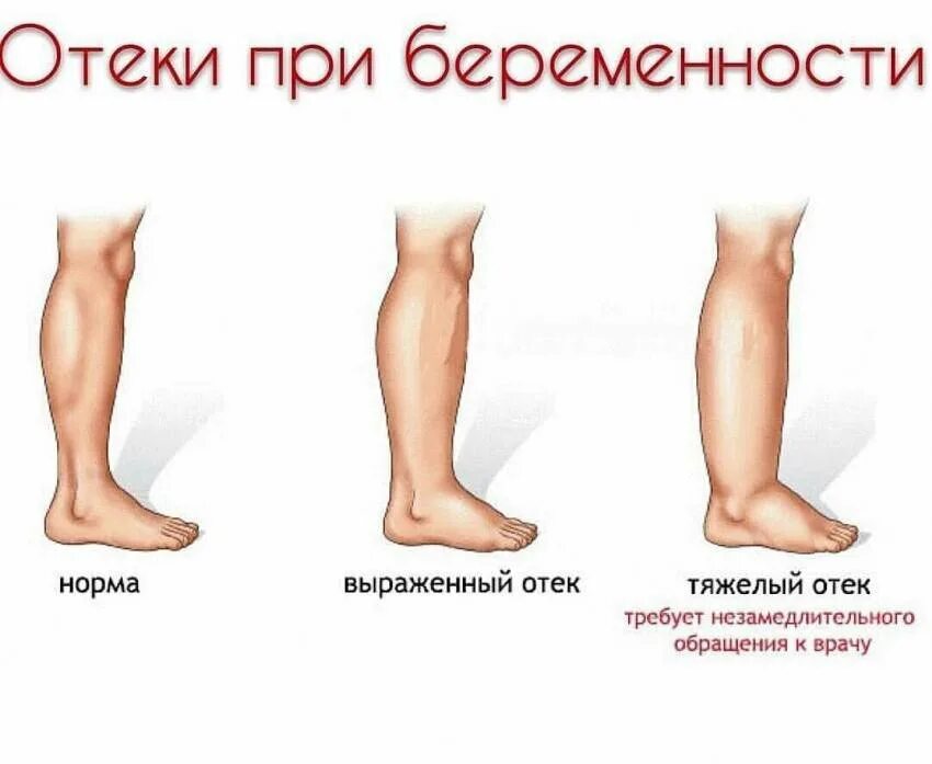 Отекают ноги причины у женщин после 60. Отекают ноги причины у женщин после 60
