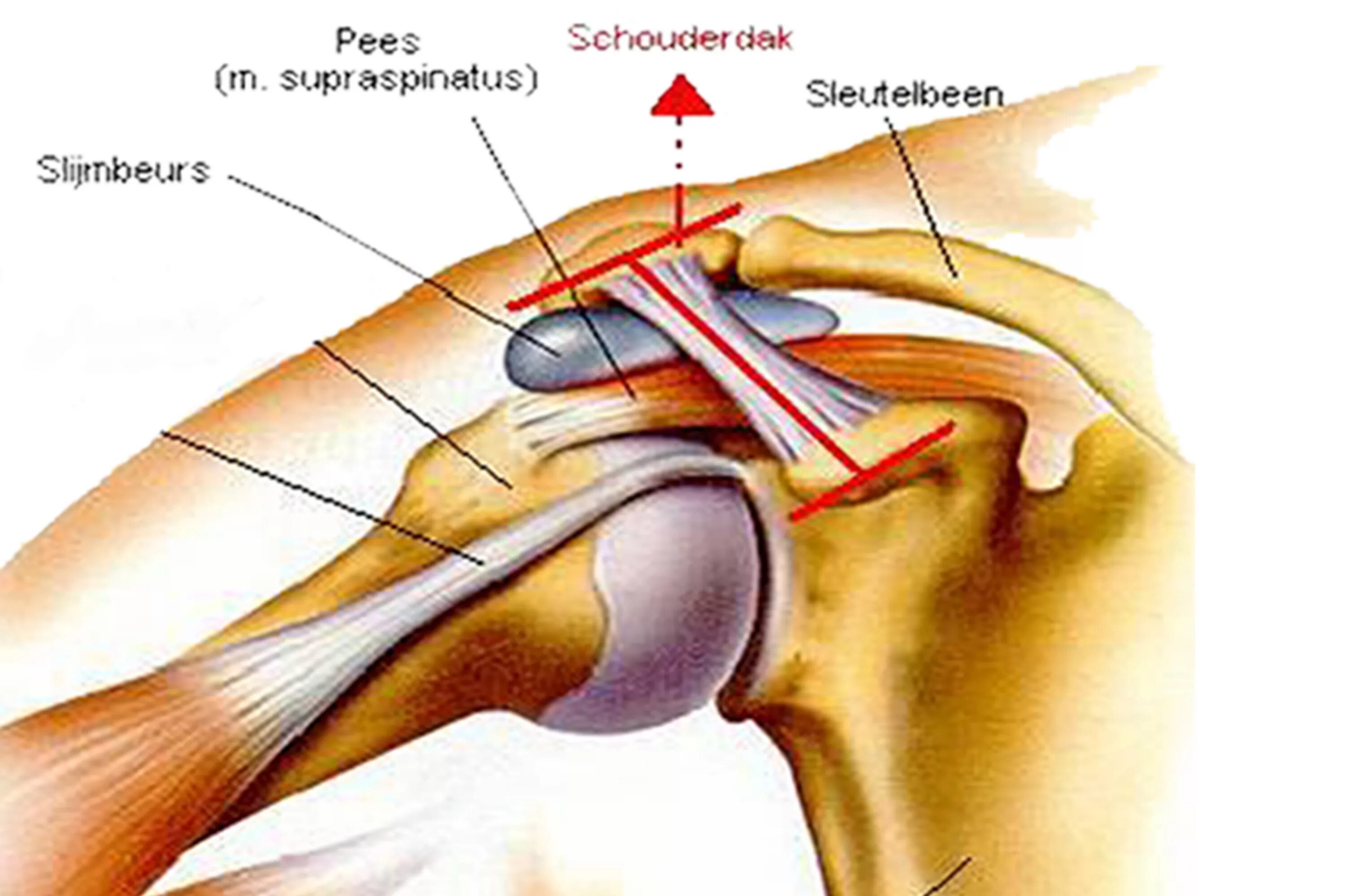 Плечевые связки. Тендинит сухожилия надостной мышцы. Тендинит надостной мышцы плечевого сустава. Тендиноза сухожилия надостной мышцы. Поражение сухожилия надостной мышцы.