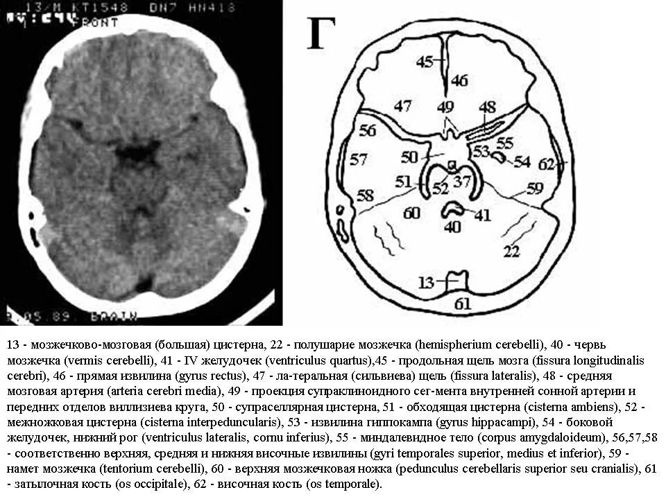 Цистерны мозга расширены. Базальные цистерны анатомия. Расширение мозжечковой цистерны кт. Базальные цистерны головного мозга кт анатомия.