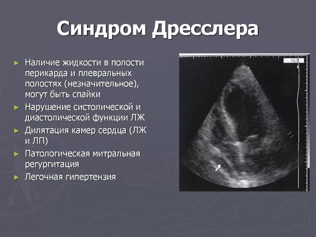 Синдром дресслера это. Синдром Дресслера механизм развития. Патологическая анатомия синдрома Дресслера. Экссудативный перикардит ЭХОКГ.