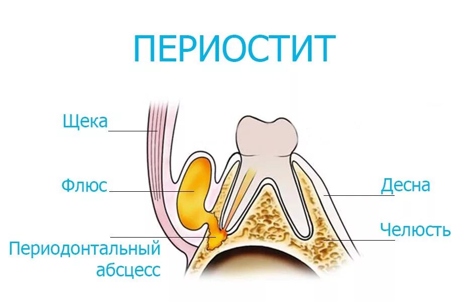 Как выглядит свищ на десне у ребенка Абсцесс десны: причины, симптомы и лечение в статье стоматолога-имплантолога Стр