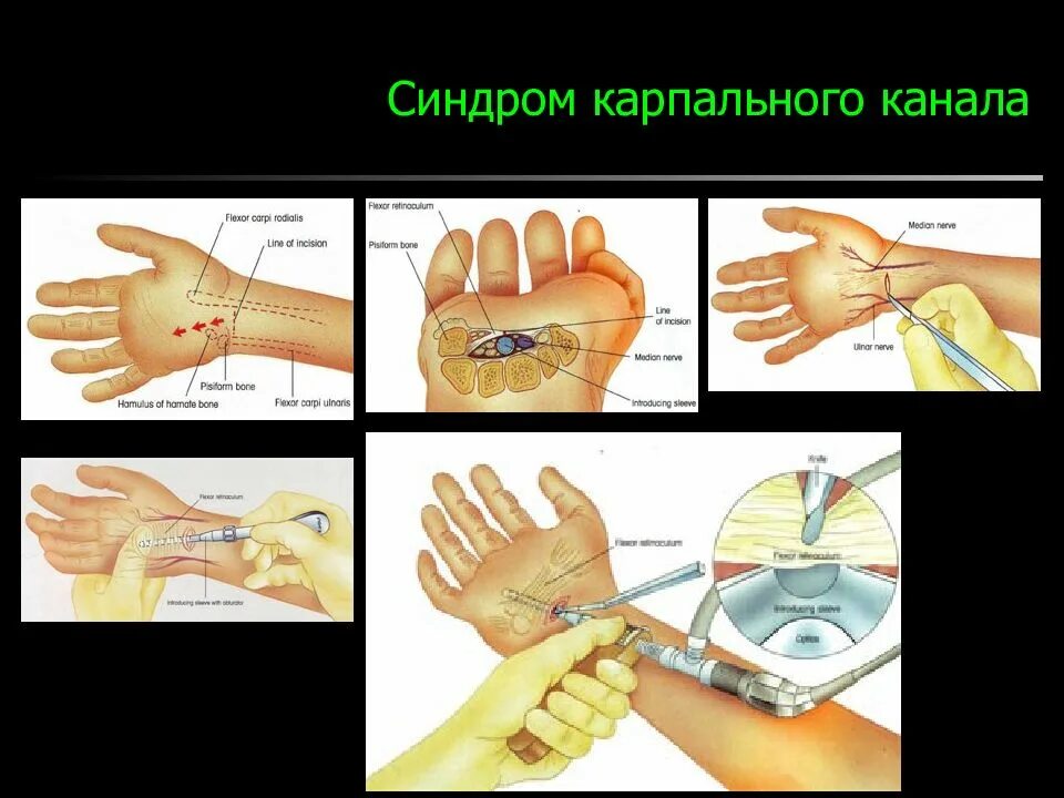 Операция синдром. Карпальный синдром кисти. карпальный туннельный синдром операция. карпальный туннельный синдром запястья операция. стндоои карпаььного канаьп.