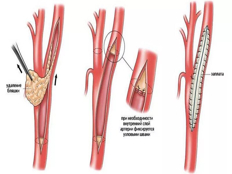 Артерия тромб удаление