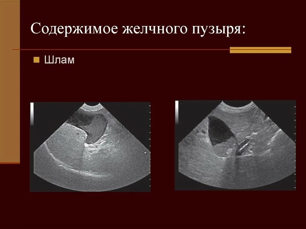 Содержимое желчного пузыря. Гомогенное содержимое желчного пузыря что это такое. Ультразвуковое исследование желчного пузыря. Гетерогенное содержимое в желчном пузыре.