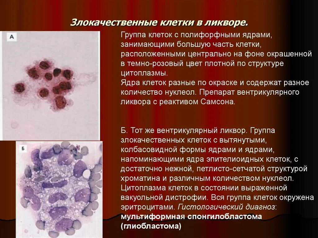 Цитологическое исследование пунктата. Цитология ликвора микроскопия. Лимфоциты и нейтрофилы в ликворе. Злокачественные клетки в ликворе. Плазматические клетки в ликворе.