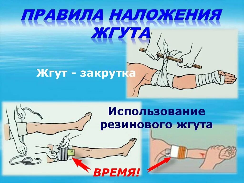 Жгут следует применять при кровотечении. Правила наложения жгута. правила надожение жгута. прибавила наложения жгута.