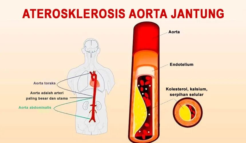 Атеросклероз грудного отдела аорты. Клинические проявления атеросклероза аорты. Атеросклероз восходящего отдела аорты. Атеросклеротическое поражение восходящего отдела аорты.