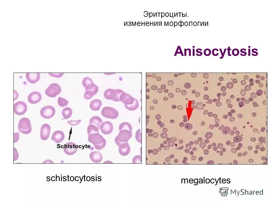 Анизоцитоз, морфология эритроцитов. Эритроциты измененные у ребенка. Анизоцитоз, морфология эритроцитов. Неизмененные эритроциты в моче микроскопия. Эритроциты в моче.