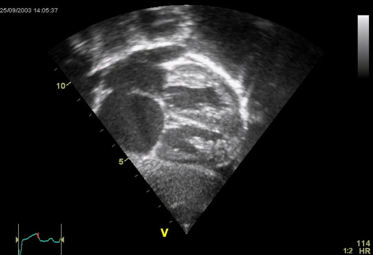 Аневризма перегородки у ребенка. Дефект межпредсердной перегородки УЗИ. Дефект межпредсердной перегородки ЭХОКГ.
