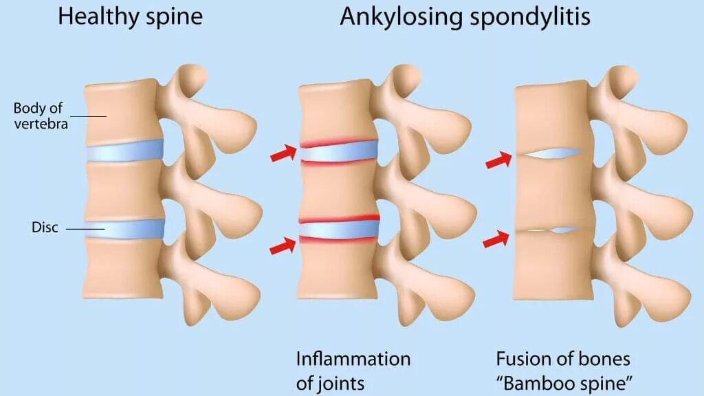 Анкилозирующий спондилит позвоночника. Анкилозирующий спондилоартрит болезнь Бехтерева. Анкилозирующий спондилит болезнь Бехтерева. Терапия анкилозирующего спондилита. Спондилез l3