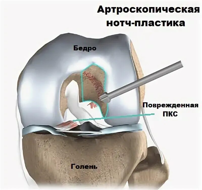 Передняя крестообразная связка после операции. ПКС (передняя крестообразная связка). Пластика передней крестообразной связки коленного сустава. Операция пластика крестообразной связки. Артроскопия ПКС коленного сустава.