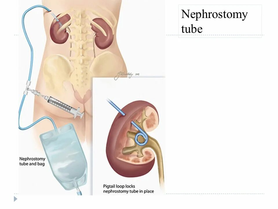 Гидронефроз почек ,нефростома. Чрескожная нефростомия почки. Нефростома схема установки. Почечный катетер для нефростомы.