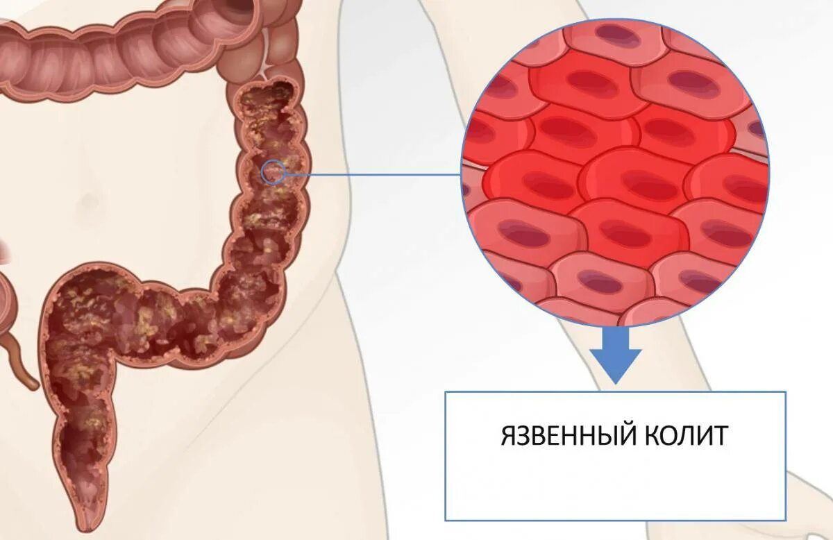 Заболевание кишечника симптомы и лечение у женщин