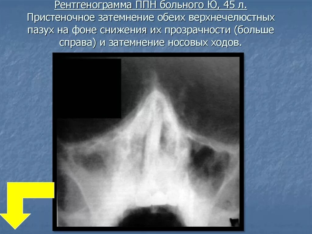 Пристеночное утолщение слизистой оболочки. Субтотальное затемнение верхнечелюстных пазух рентген. Тотальное затемнение верхнечелюстной пазухи рентген. Рентген ППН затемнение пазух. Рентгенография придаточных пазух носа синусит.