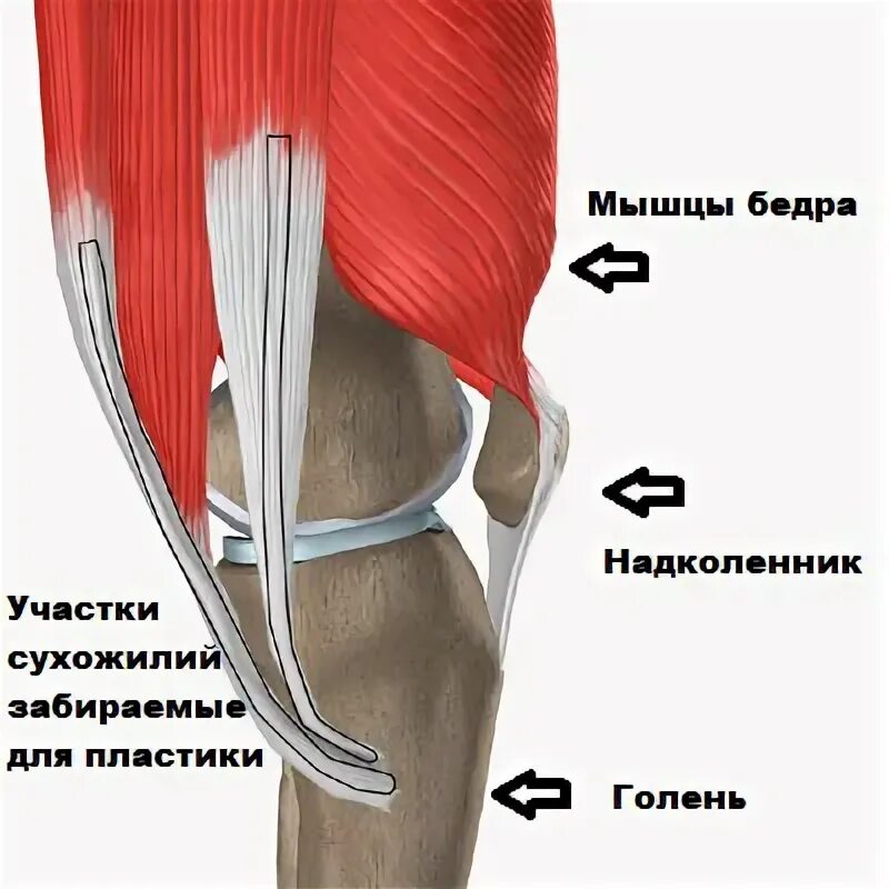Как лечить гусиную лапку
