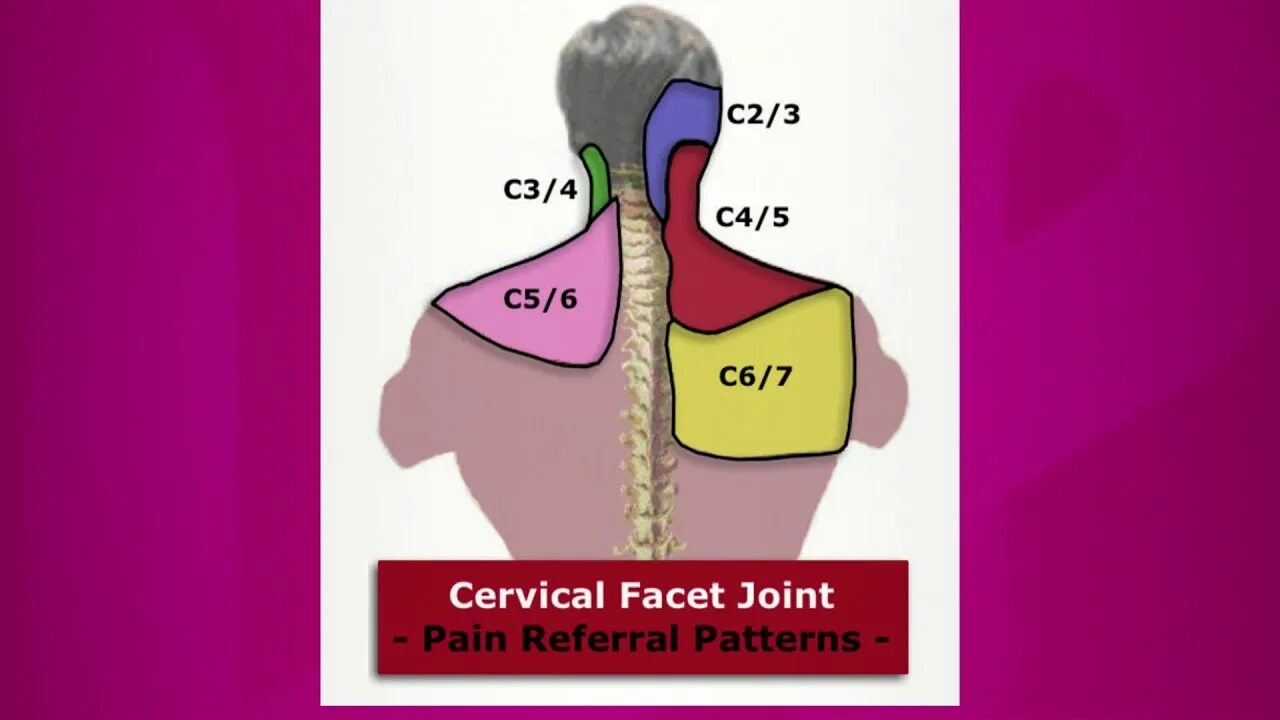 Cervical Spine c6 and c7. Cervical контейнер. Facet перевод