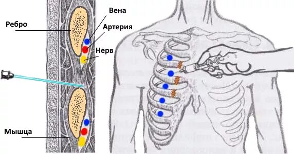 Межреберная блокада. Блокада при межреберной невралгии техника. Блокада межреберных нервов техника. Блокада нерва при межреберной невралгии. Новокаиновая блокада межреберных нервов.