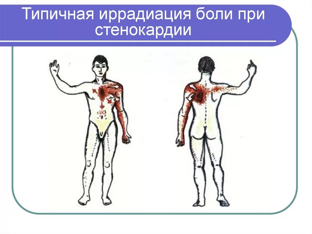 Симптом иррадиации. Локализация боли при стенокардии. Типичная иррадиация болей при стенокардии. Типичная локализация боли при стенокардии. Иррадиация боли при стенокардии.