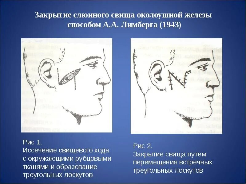 Околоушная железа операция. Киста и свищ околоушной области.