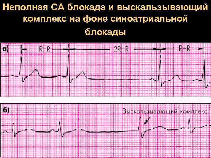 Комплекс блокада