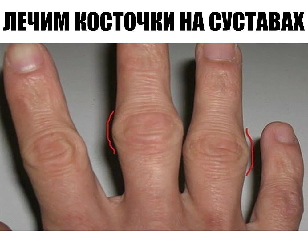 Как лечить средний палец