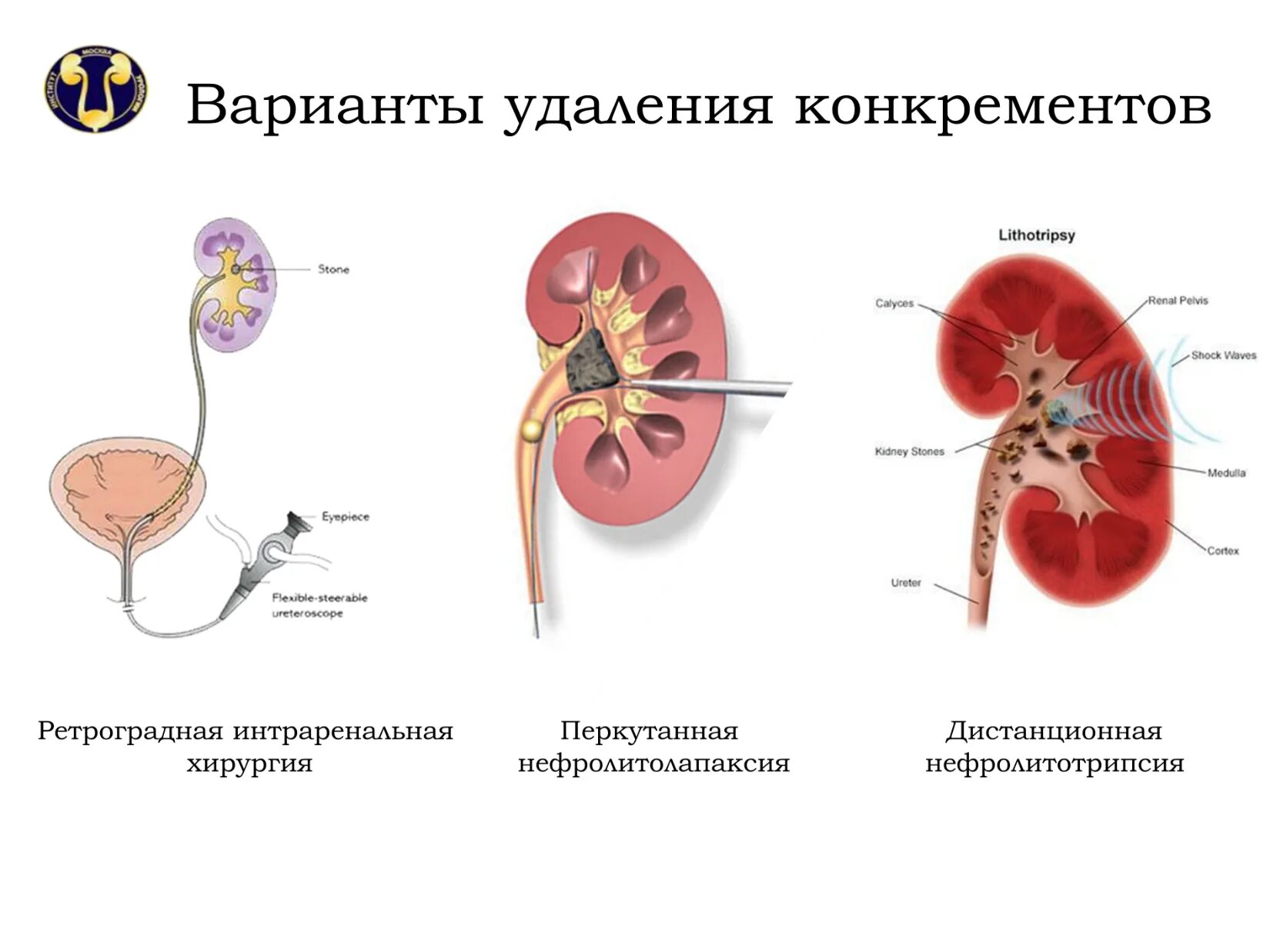 Мочекаменная болезнь урология камни мочеточника. Мочекаменная болезнь операция. Хирургическое вмешательство при мочекаменной болезни. Мочекаменная болезнь схема.