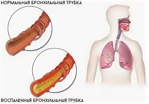 Сильный кашель до рвоты что делать. Сильный кашель до рвоты у взрослого. Бронхит кашель до рвоты. Рвота при сильном кашле.