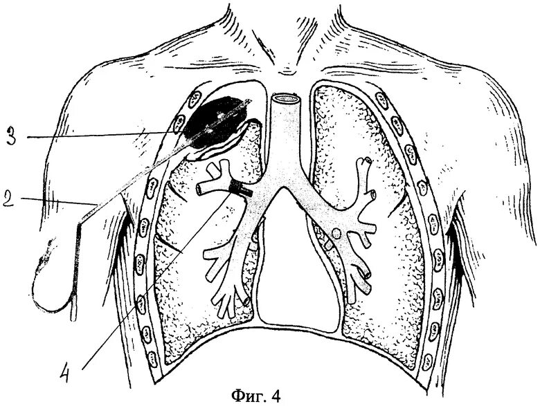 Операция левого легкого. Экстраплевральный пневмоторакс. Экстраплевральный пневмоторакс при туберкулезе. Экстраплевральный пневмолиз это. Экстраплевральная пломбировка при туберкулезе.