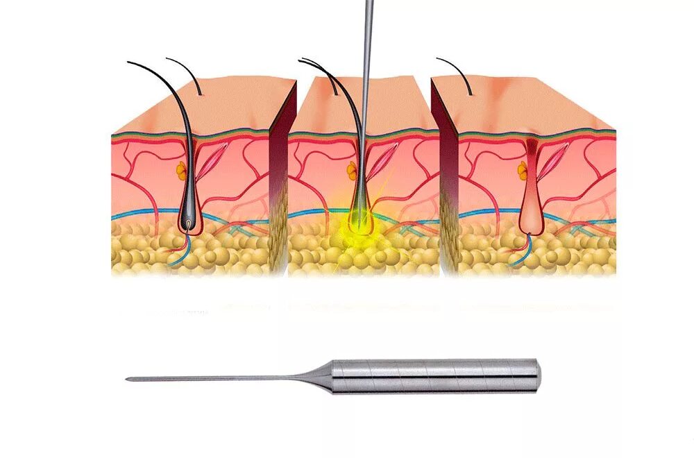Термолиз электроэпиляция. Электроэпиляция Микротерм. Иглы электроды для электроэпиляции. Электроэпиляция бикини.иглой.