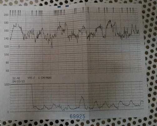 Тонус по КТГ. Тонус на КТГ как выглядят. Тонус матки на КТГ. КТГ тонус матки норма. Тонус на 39 неделе