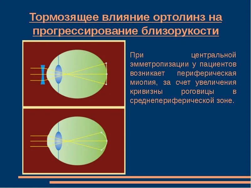 Прогрессирование миопии. Прогрессирование близорукости. прогрессирование осевой миопии. замедление прогрессирования миопии. теории развития близорукости.