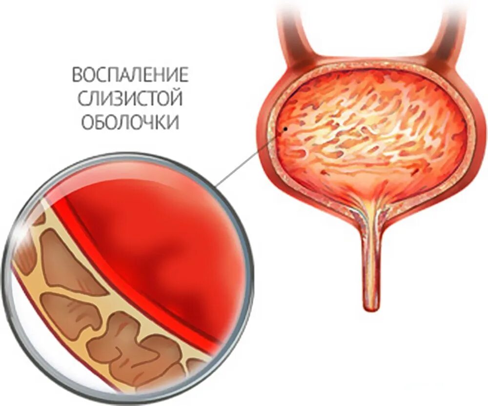 Больной мочевой. Цистит воспаление мочевого пузыря. Воспаление слизистой оболочки мочевого пузыря.