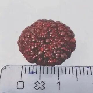 Как убирают камни в мочевом