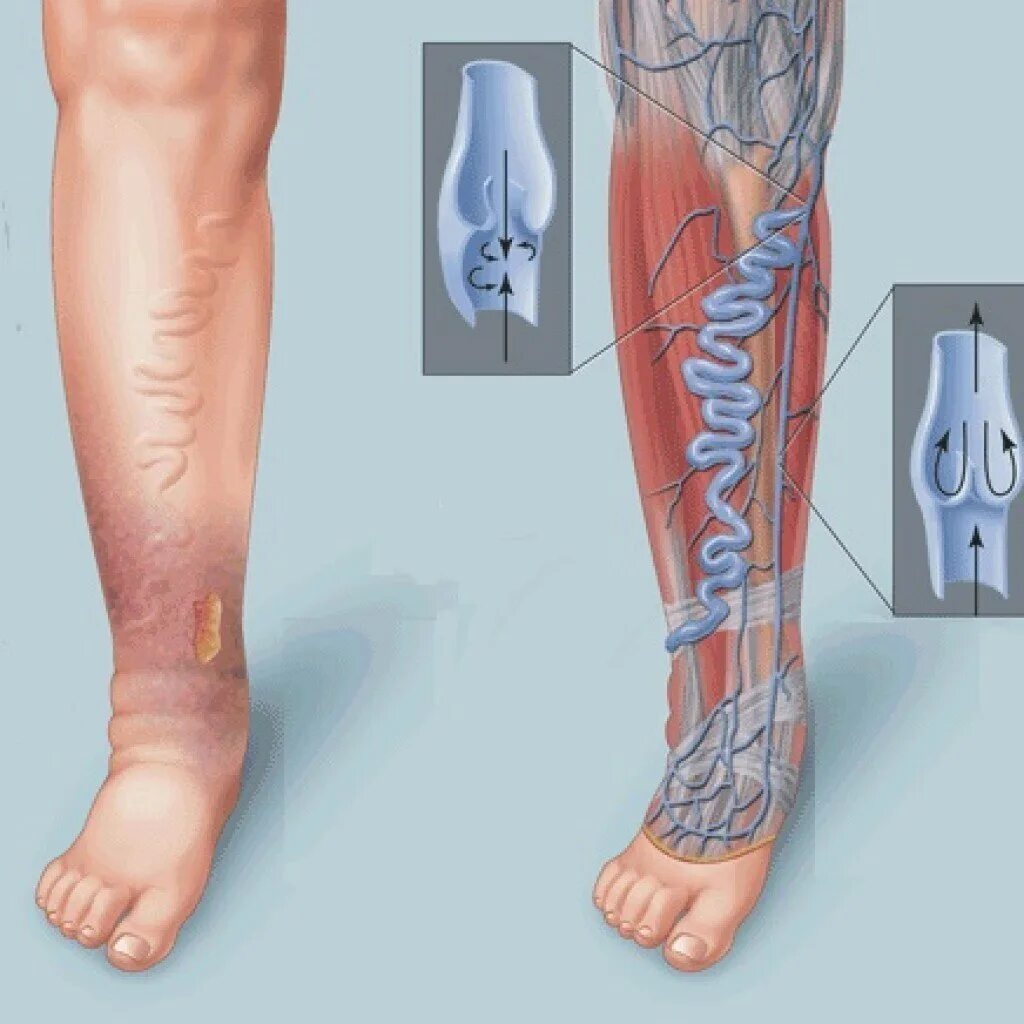 Почему хромает нога. Хроническая венозная недостаточность (ХВН). Варикозное расширение вен нижних конечностей ХВН. Варикозное расширение вен нижних конечностей ХВН с2 3s.