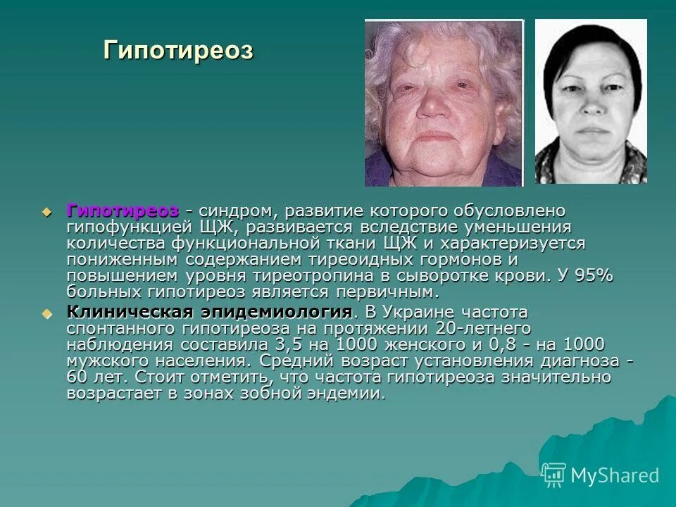 3 гипотиреоз. Гипотиреоз объективно.