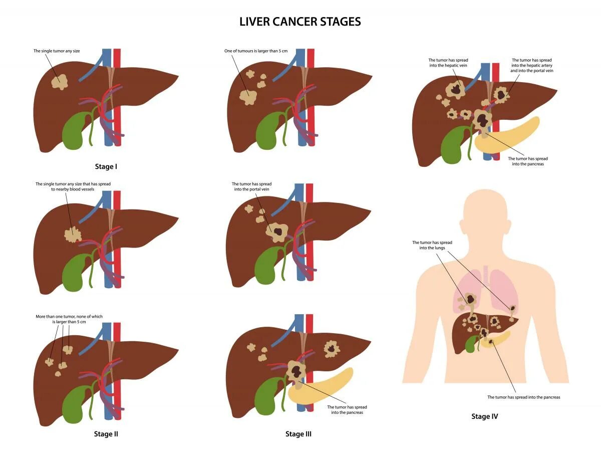 Рак печени 4 стадии прогноз. Злокачественные образования печени.